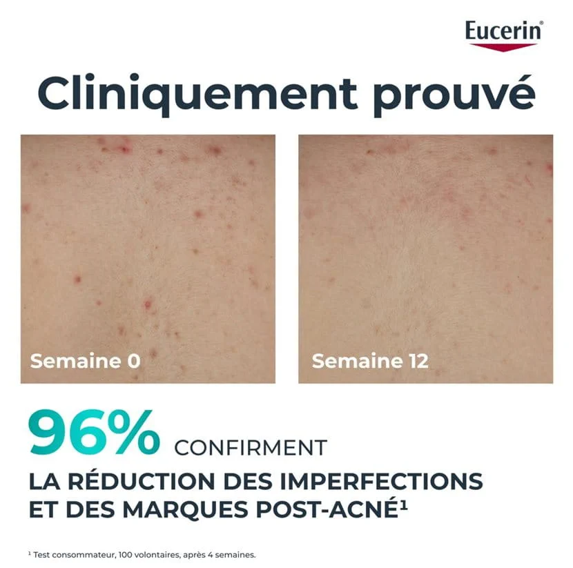 EUCERIN Dermopure Crème Corps Triple Action 200ml Acné Corporelle Exfolie Hydrate - Image 3