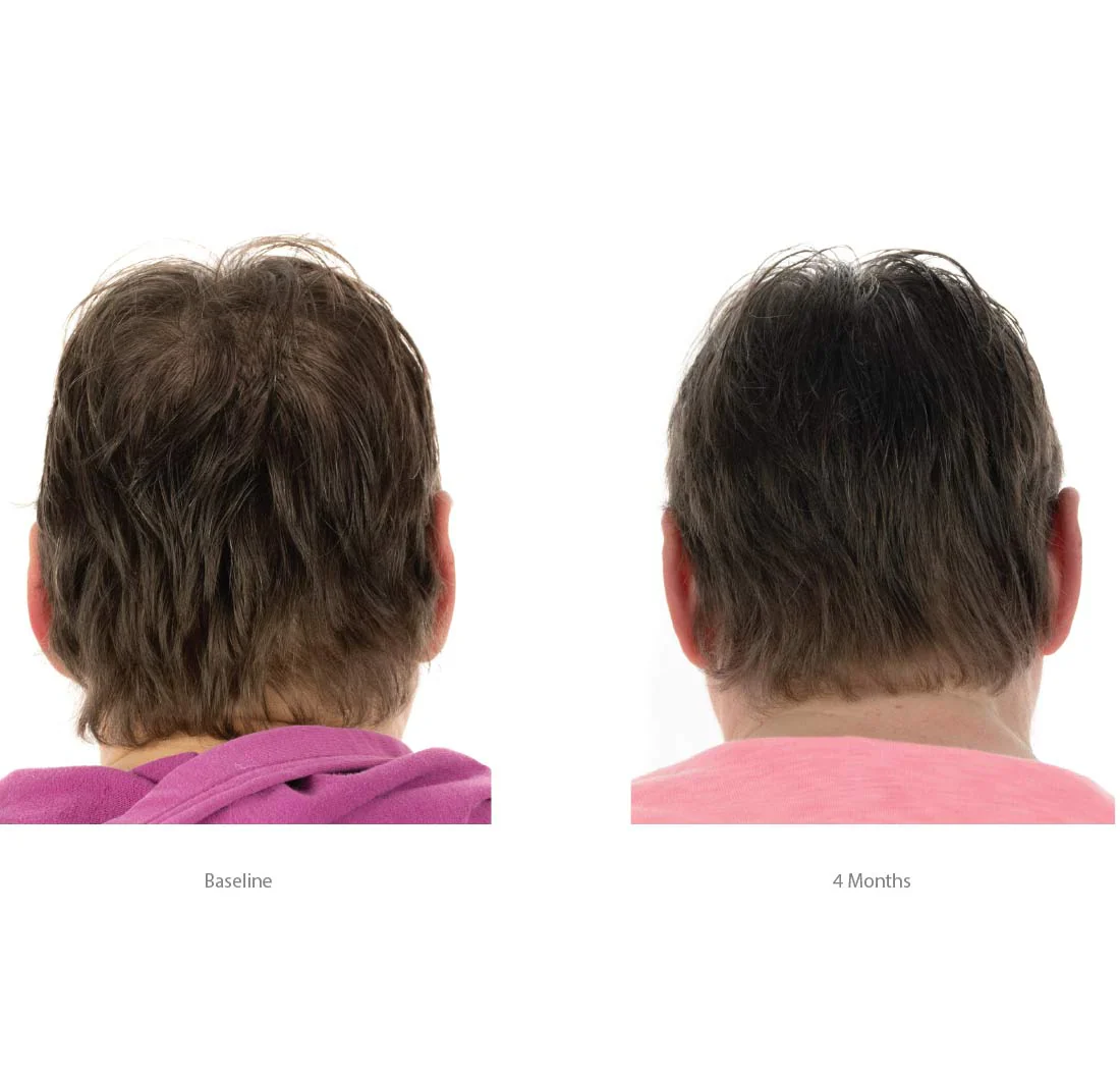 FOLIGAIN Triple Action Conditioner Trioxidil 2% Femme Après-Shampoing Anti-Chute Cheveux Densité Volume Croissance Capillaire - Image 5