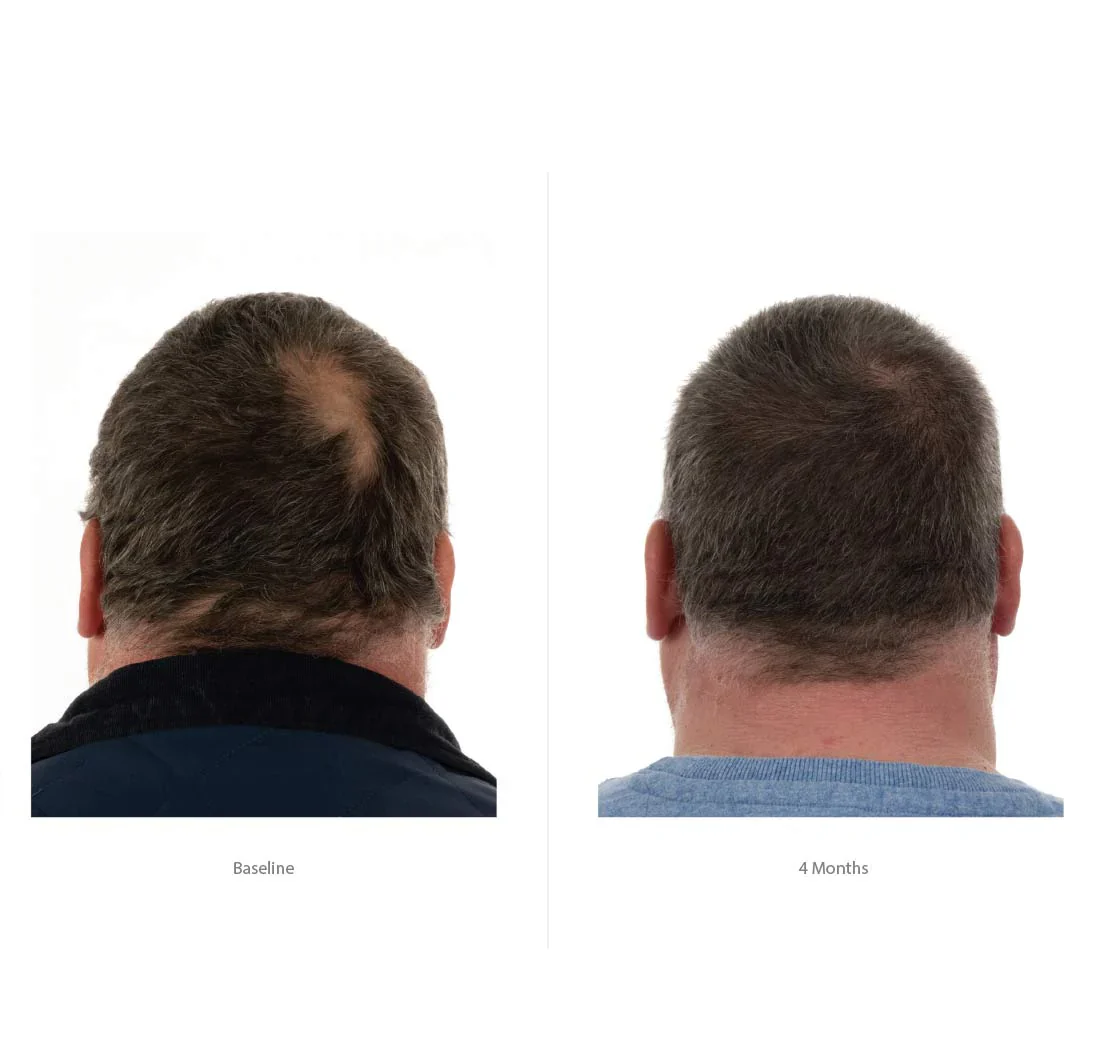 FOLIGAIN Triple Action Conditioner Trioxidil 2% Homme Après-Shampoing Anti-Chute Cheveux Densité Volume Croissance Capillaire - Image 6
