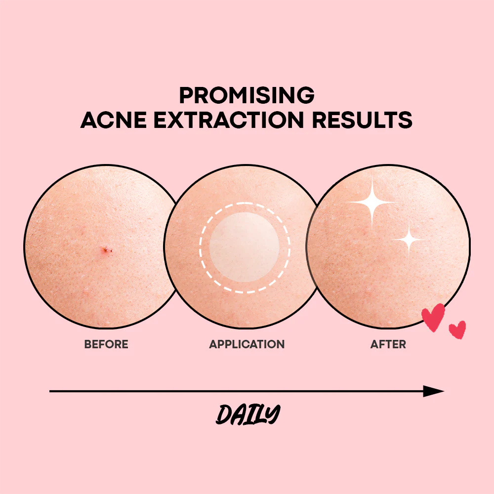 NOLAHOUR Clear Spot Patch 26 Patchs Anti-Imperfections Boutons Acné Invisible Hydratation - Image 4