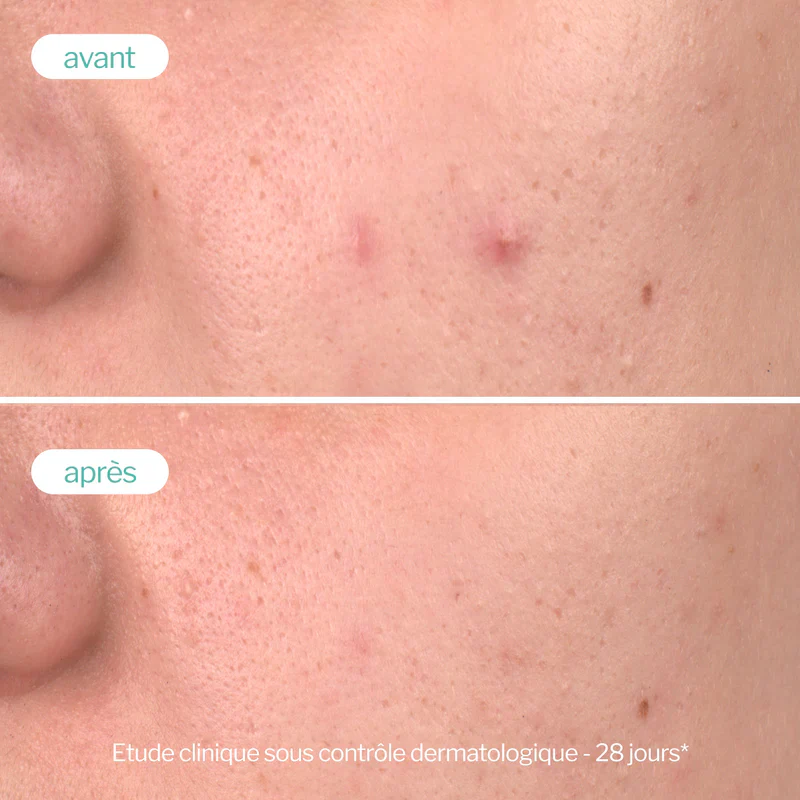 NOVEXPERT Soin Peeling Peau Nette Trio Zinc 30ml Exfoliant Doux Anti-Imperfections Pores Resserrés Usage Quotidien - Image 4