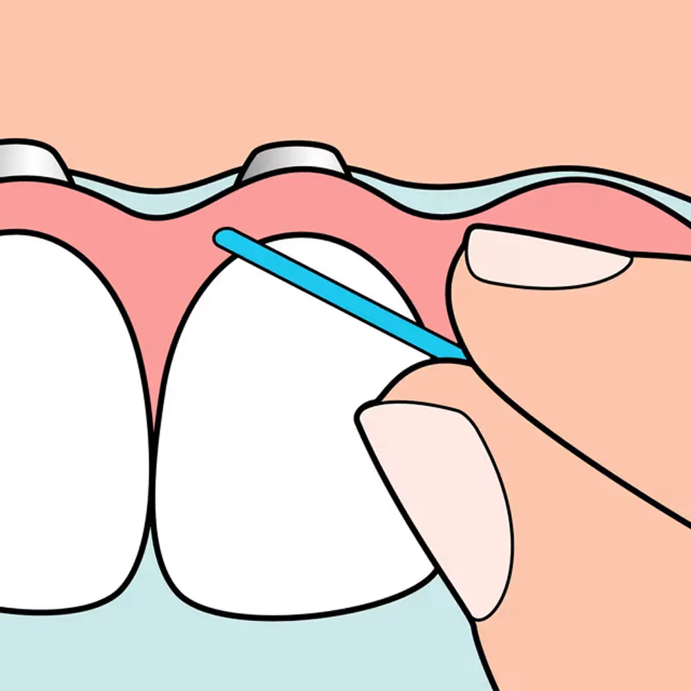 TEPE Fil Dentaire Bridge & Implant 30 Pièces Hygiène Bucco-Dentaire Bridges Implants - Image 4