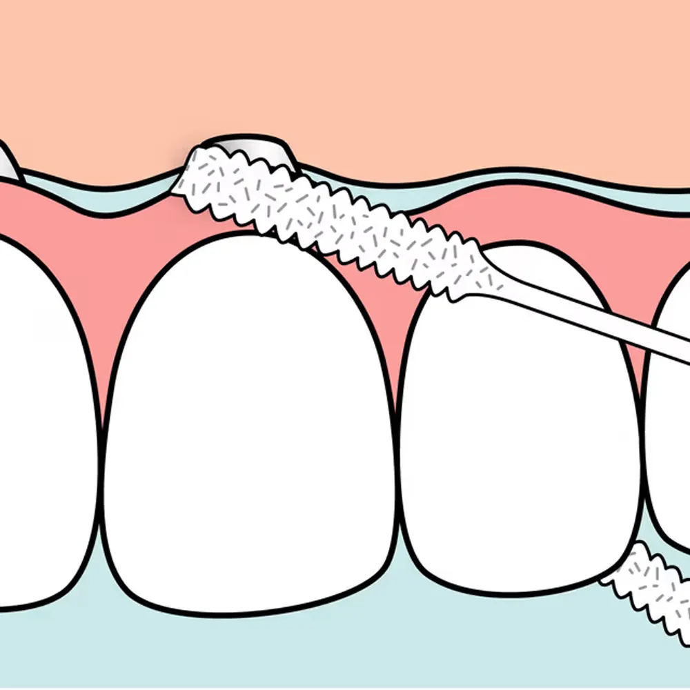 TEPE Fil Dentaire Bridge & Implant 30 Pièces Hygiène Bucco-Dentaire Bridges Implants - Image 5